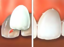 Facettes dentaires