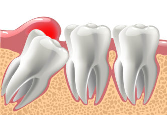 Dents De Sagesse - Concept Dentaire Rive-Sud St-Lambert